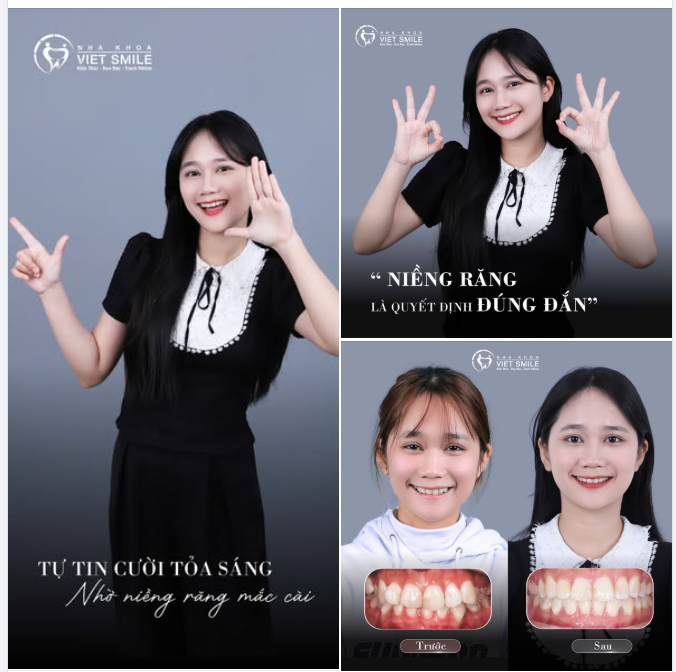 TỰ TIN TỎA SÁNG VỚI NIỀNG RĂNG MẮC CÀI