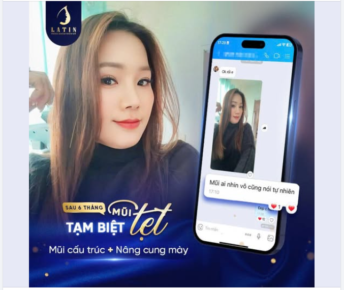 6 Tháng Sau Combo Mũi Cấu Trúc Và Nâng Cung Mày
