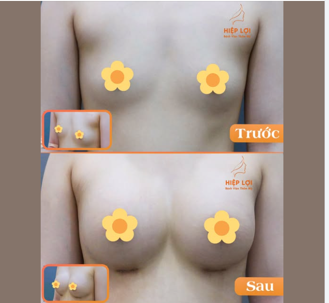 Căng tròn, tự nhiên – Chuẩn đẹp tại Hiệp Lợi