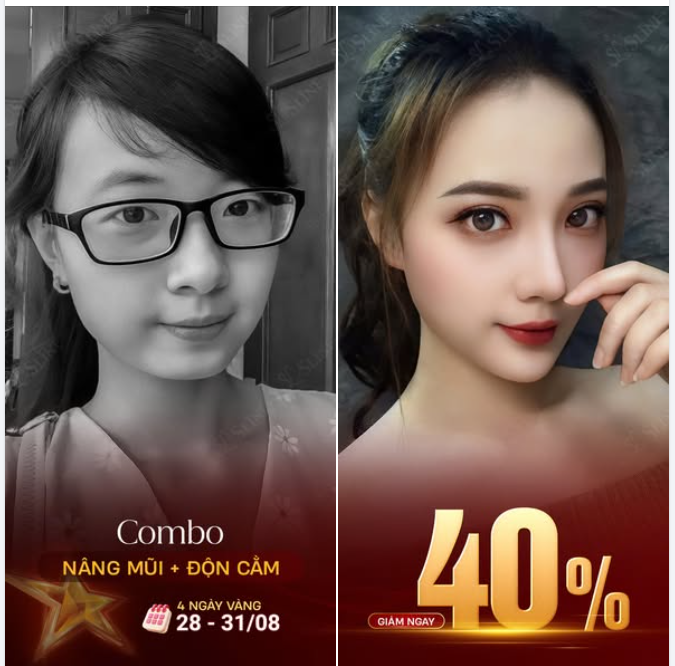 Feedback thực tế từ khách hàng sau khi lựa chọn combo nâng mũi + độn cằm với ekip Sline – gương mặt trở nên thanh thoát, cân đối và đầy tự tin.