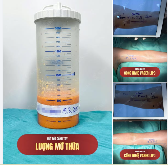 CASE THỰC TẾ – HÚT MỠ CÁNH TAY