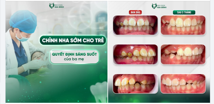 Chỉnh nha sớm cho trẻ - Quyết định sáng suốt của ba mẹ