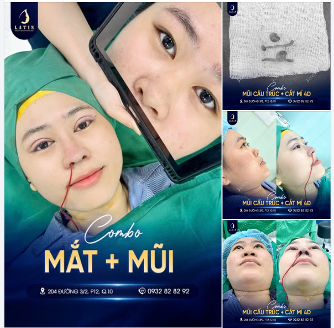 Ban đầu em gái còn lăn tăn, sợ đau, sợ đủ thứ... Ai ngờ giờ nhìn thấy rõ: làm 1 lần, thay đổi cả thanh xuân.