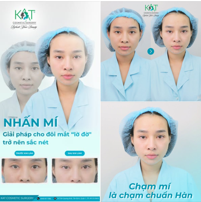 Không phẫu thuật – Không nghỉ dưỡng – Mắt rõ mí ngay sau khi làm