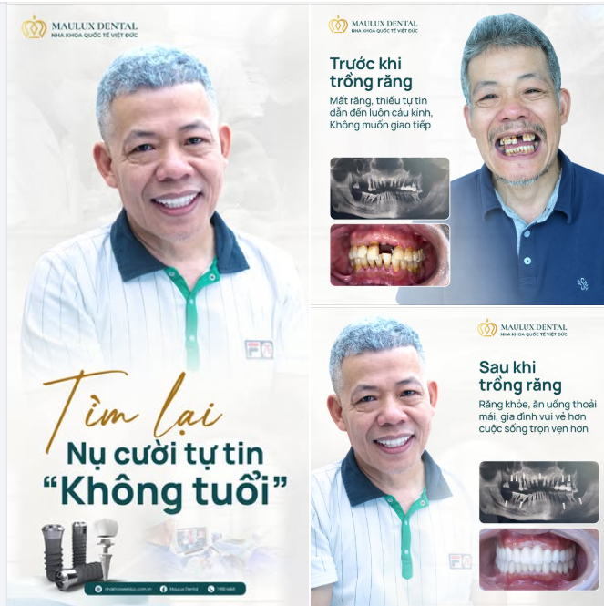 VIỆT KIỀU SÉC VỀ VIỆT NAM TRỒNG RĂNG – CHỈ 1 THÁNG PHỤC HỒI HOÀN TOÀN, ĂN NHAI THOẢI MÁI!