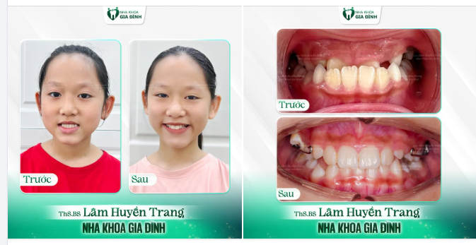 TẠM BIỆT RĂNG MÓM - ĐÓN NỤ CƯỜI XINH