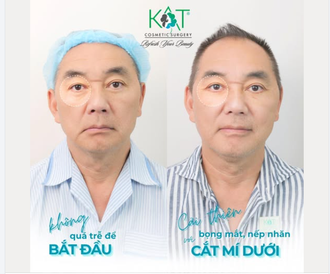 Giải pháp thẩm mỹ tinh tế – phù hợp cả nam giới ở tuổi trung niên.