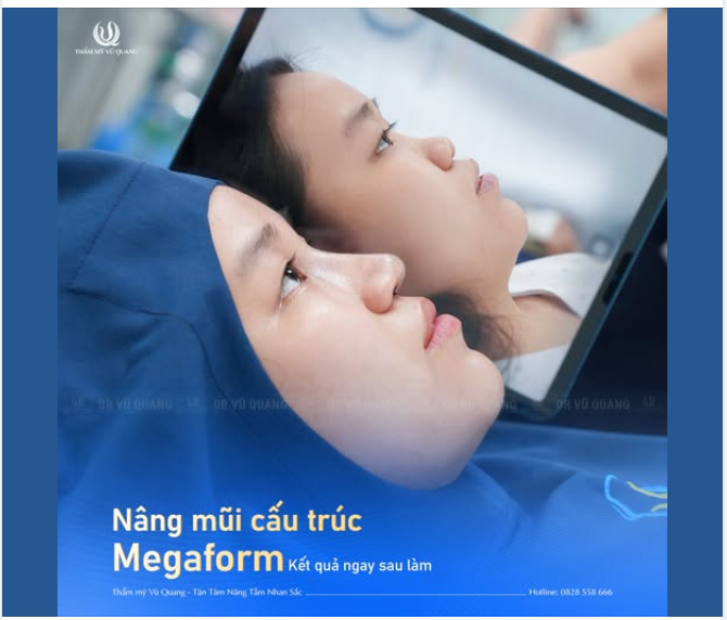 SỤN MEGAFORM - BÍ KÍP SỞ HỮU DÁNG MŨI ĐẸP BỀN VỮNG VỚI THỜI GIAN