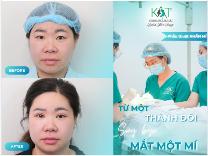 Phẫu thuật nhấn mí tại KAT – thay đổi chỉ sau 1 lần,