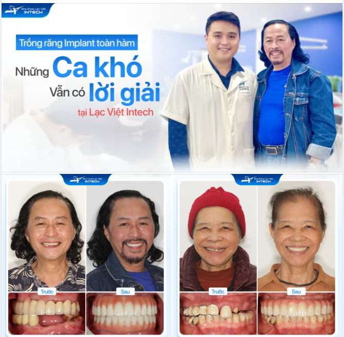 Trồng răng Implant toàn hàm - những ca khó vẫn có lời giải tại Lạc Việt Intech