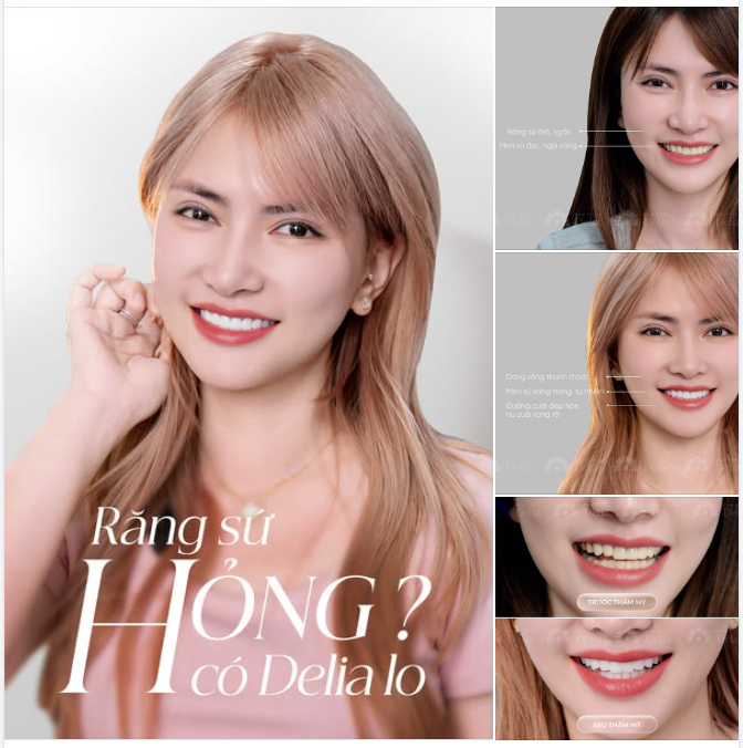Chị T. từng bọc răng sứ ở nơi khác nhưng men sứ ố vàng, hình dáng chưa hài hoà, ăn nhai cũng không thoải mái
