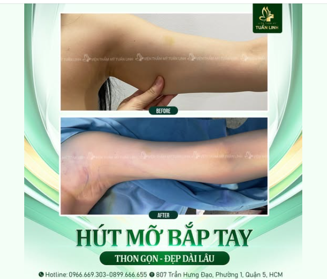 HÚT MỠ BẮP TAY CÔNG NGHỆ CAO - SỞ HỮU CÁNH TAY THON GỌN CHỈ TRONG 60 PHÚT!!