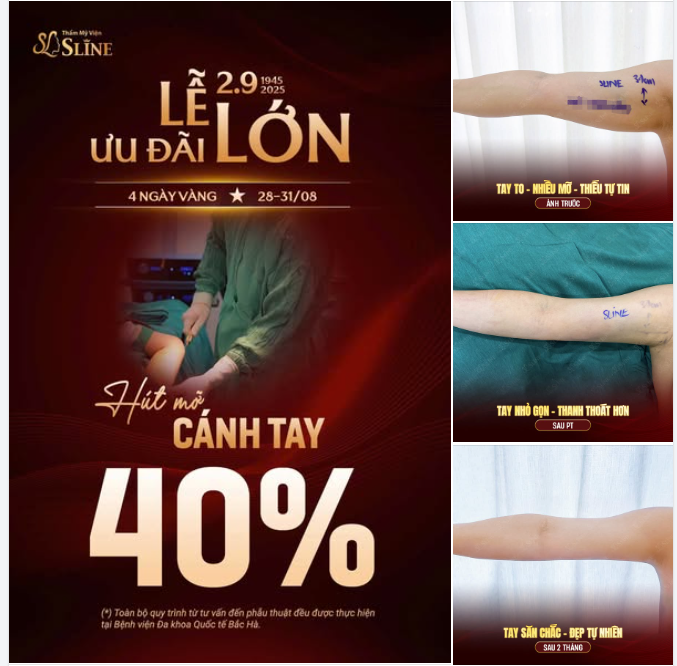 HÚT MỠ CÁNH TAY – GIẢM NGAY 40%
