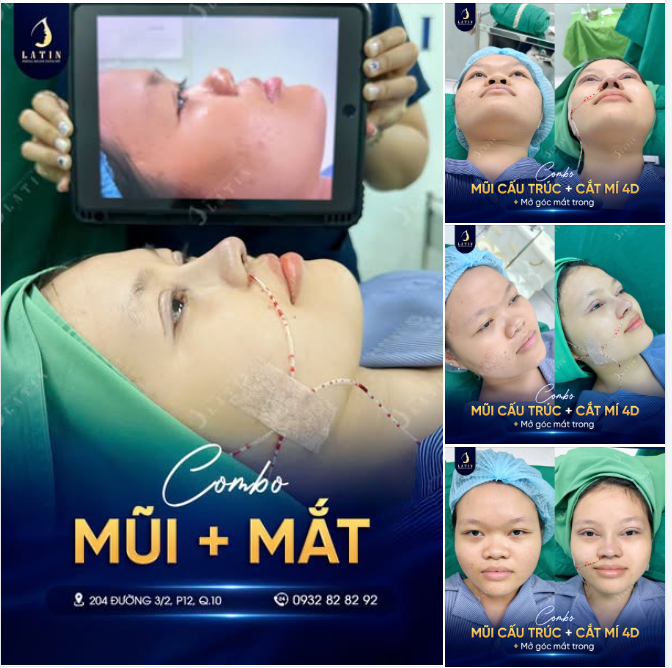 NÂNG MŨI VÀ CẮT MÍ 1 LẦN – ĐẸP TRỌN GÓC NHÌN