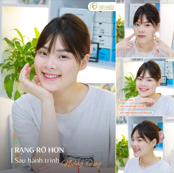 THÁO NIỀNG RĂNG – KHÉP LẠI NỖI LO THƯA RĂNG VÀ MẤT RĂNG 6