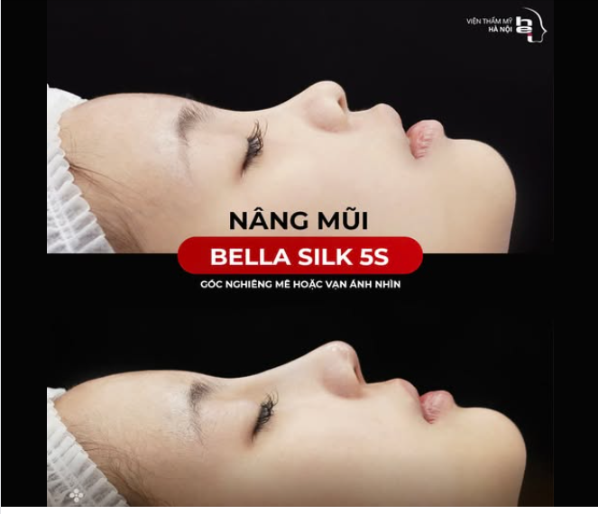 NÂNG MŨI BELLA SILK 5S - MŨI ĐẸP MẶT XINH