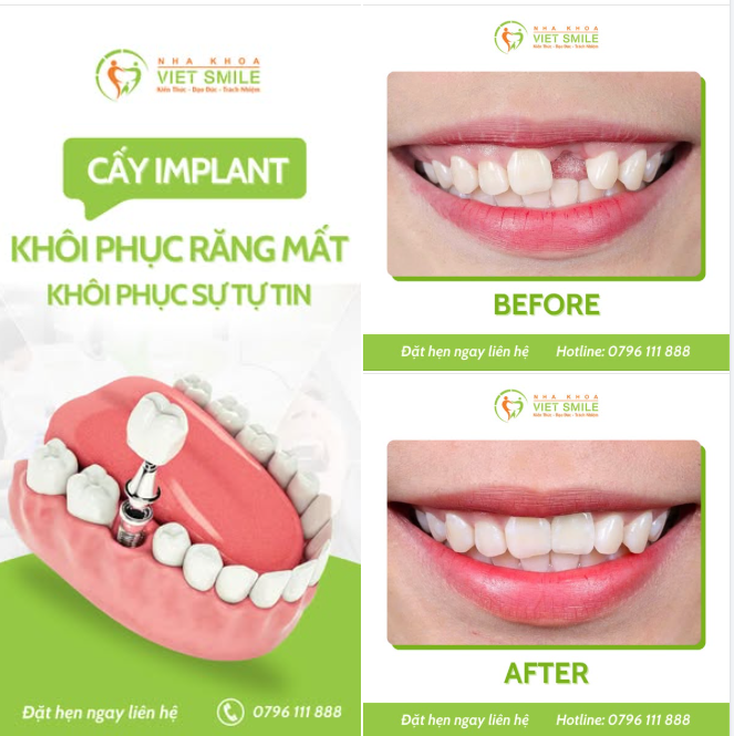 TRỒNG IMPLANT – KHÔNG CHỈ LẤY LẠI RĂNG MẤT, MÀ CÒN LẤY LẠI NỤ CƯỜI