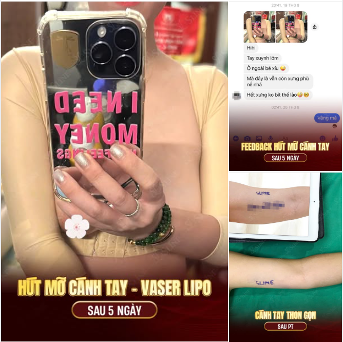 FEEDBACK KHÁCH HÀNG HÚT MỠ CÁNH TAY