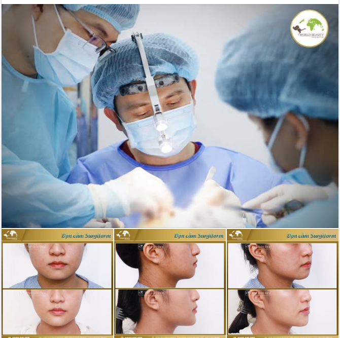 Hoàn thiện nhan sắc cho Cô nàng 2k4 với phương pháp độn cằm bằng sụn sinh học và tất tần tật về kỹ thuật độn cằm mà bạn nên biết!