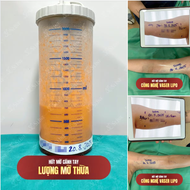 CASE THỰC TẾ – HÚT MỠ CÁNH TAY