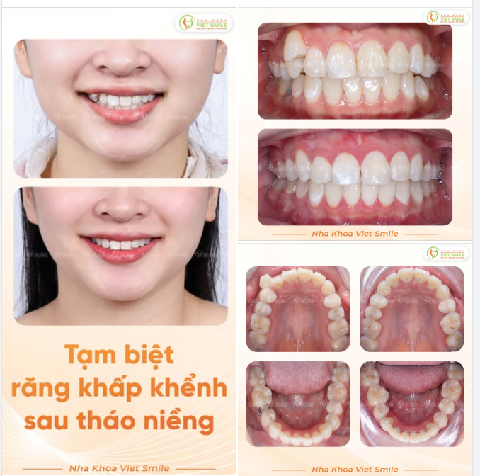 NIỀNG MẮC CÀI – TẠM BIỆT RĂNG KHỂNH, ĐÓN NỤ CƯỜI CÂN ĐỐI