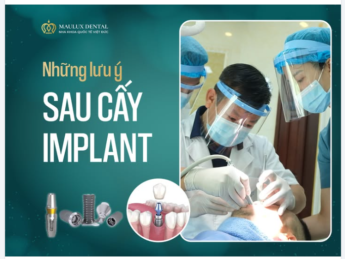 CẤY GHÉP IMPLANT – NHỮNG LƯU Ý VÀNG CHO QUÁ TRÌNH HỒI PHỤC AN TOÀN