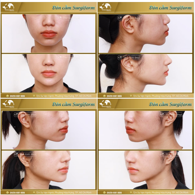 Phương pháp này không chỉ phù hợp với độ tuổi, mà còn đảm bảo an toàn, giữ được sự tự nhiên – đúng với mong muốn của Khách hàng trẻ tuổi.