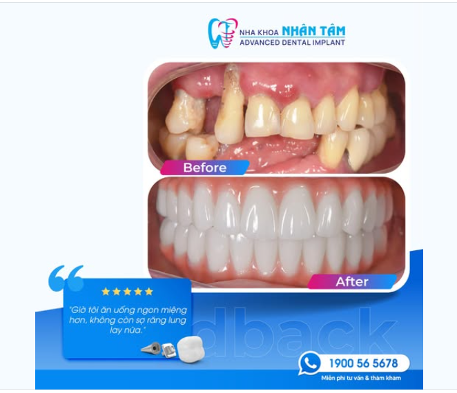 VIÊM NHA CHU – THỦ PHẠM THẦM LẶNG GÂY MẤT RĂNG TOÀN HÀM