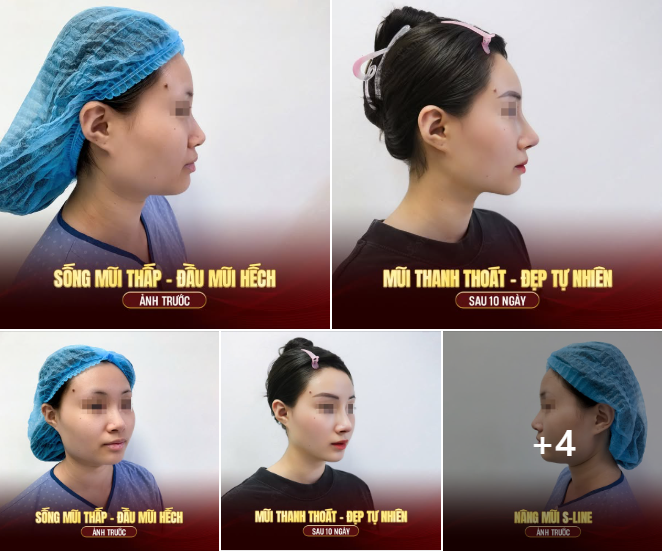FEEDBACK KHÁCH HÀNG – NÂNG MŨI S-LINE