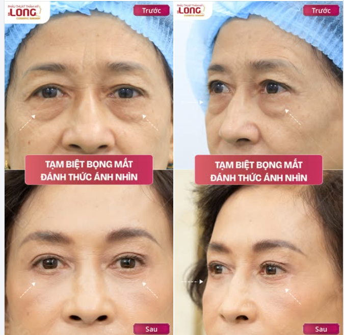 XÓA TAN BỌNG MẮT​​​​​​​ ĐÁNH THỨC ÁNH NHÌN