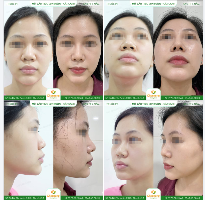 Sau khi được tư vấn, nàng quyết định thực hiện nâng mũi cấu trúc sụn sườn kết hợp cắt cánh mũi để cải thiện toàn diện.
