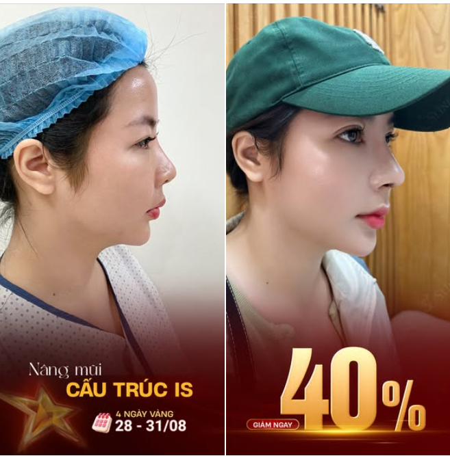 NÂNG MŨI – BÍ QUYẾT CHO GƯƠNG MẶT THANH THOÁT