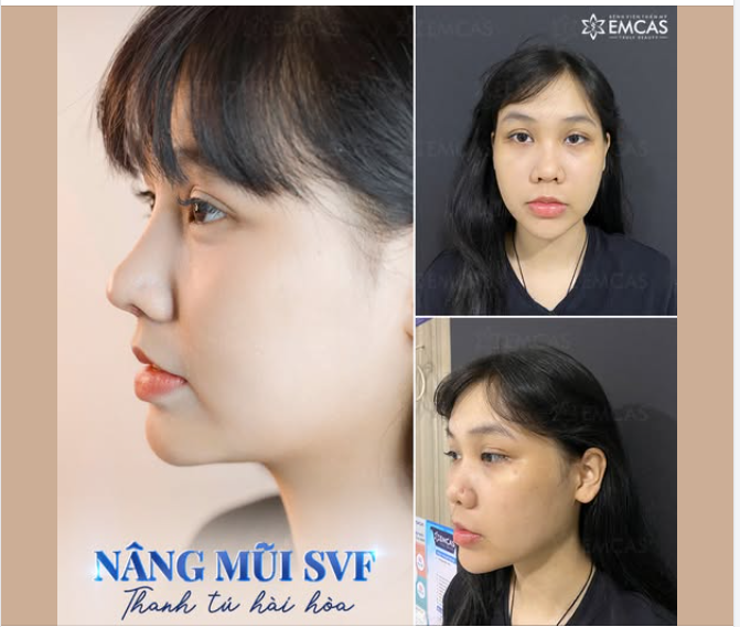 Dáng mũi thay đổi tổng thể diện mạo