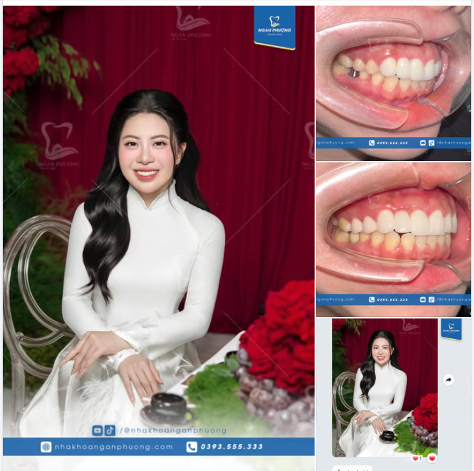 Cảm ơn bạn Diệu Huyền đã lựa chọn Nha khoa Ngân Phượng cho nụ cười khỏe đẹp trọn vẹn