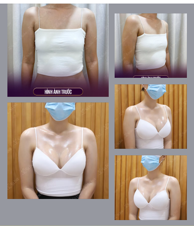 Vòng 1 được nâng cấp khéo léo, cân đối, mềm mại tự nhiên – giúp chị khách tự tin hơn từng ngày.