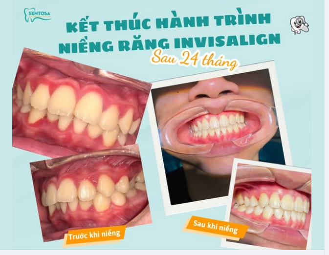 HÀNH TRÌNH TỪ 24 THÁNG NIỀNG INVISALIGN – NỤ CƯỜI HOÀN HẢO TỪNG MILIMET