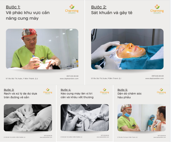 NÂNG CUNG MÀY – GIẢI PHÁP CHO ĐÔI MẮT TƯƠI TRẺ HƠN