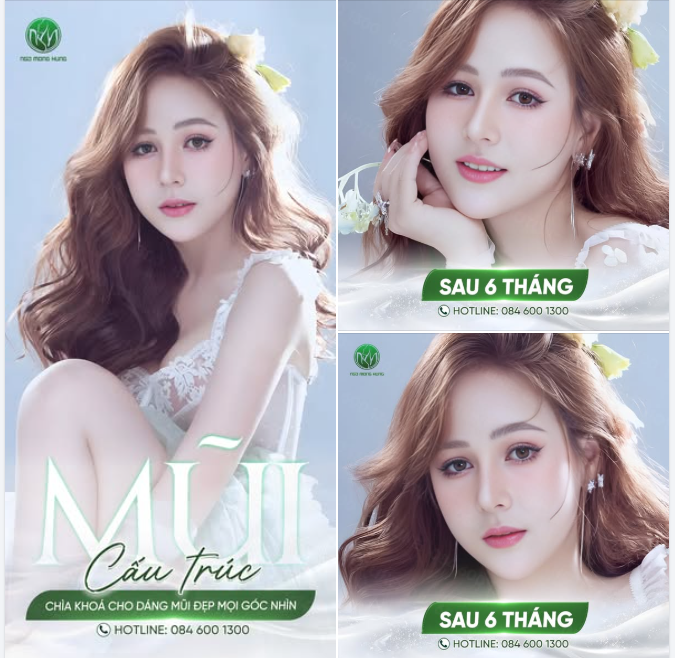 MŨI CẤU TRÚC S-LINE - CHÌA KHÓA CHO DÁNG MŨI ĐẸP MỌI GÓC NHÌN