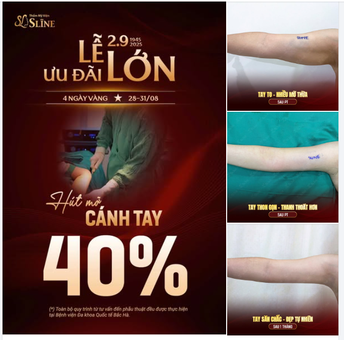 HÚT MỠ CÁNH TAY – DEAL HOT 4 NGÀY VÀNG