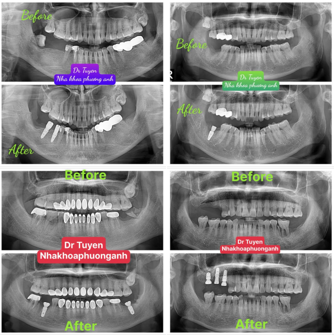 Vật liệu làm implant nha khoa từ gì? có an toàn không?