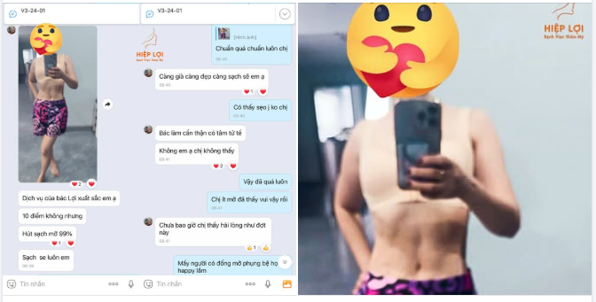 Lời chia sẻ đáng yêu từ khách hàng sau khi hút mỡ bụng tại Bệnh viện Thẩm mỹ Hiệp Lợi