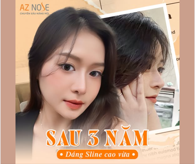 Và đây là dáng mũi sau 3 năm được Bác sĩ Hoàng Nhung bảo: "Nhắm mắt đi bác nặn cho"!