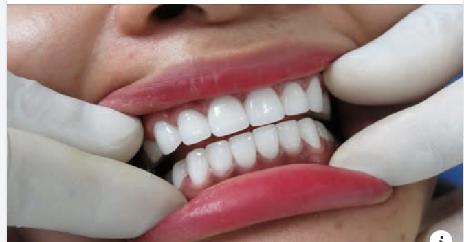 Cảm giác sau khi bọc răng sứ và Những điều bất thường cần lưu ý