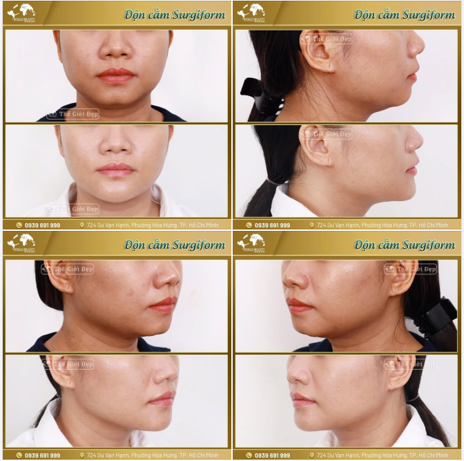 Đây là lựa chọn lý tưởng cho những ai muốn sở hữu gương mặt chuẩn tỷ lệ vàng mà không phải lo lắng về hiệu quả ngắn hạn như các phương pháp tạm thời.