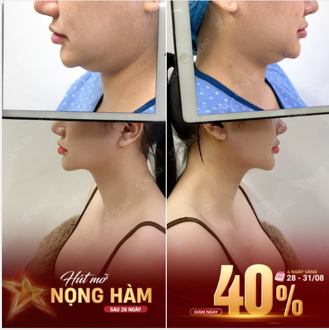 HÚT MỠ NỌNG CẰM – GƯƠNG MẶT THANH THOÁT HƠN