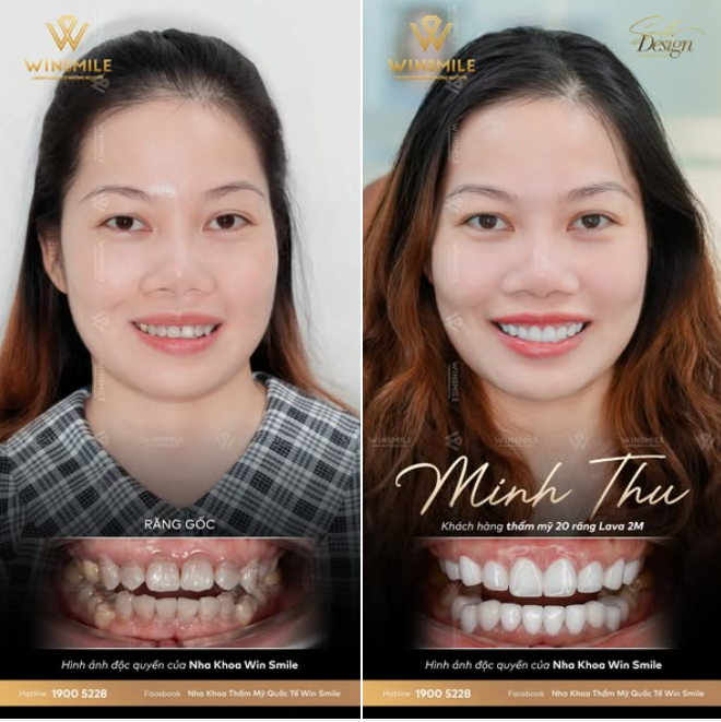 NỤ CƯỜI BẬT TONE TRẮNG SÁNG - DIỆN MẠO “BẬT MODE” TỰ TIN