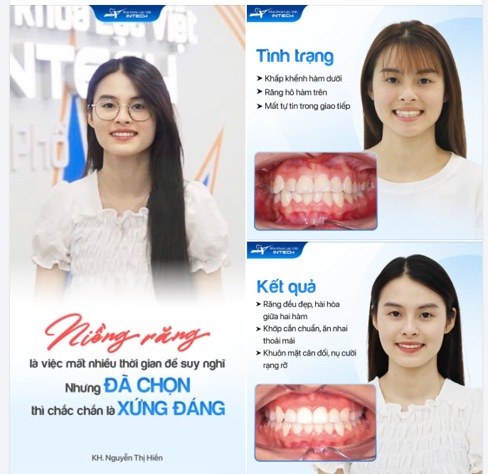 Nụ cười chưa trọn vẹn khiến Hiền trước đây hay e dè khi giao tiếp và nhiều lần đắn đo trước quyết định có nên niềng răng hay không.