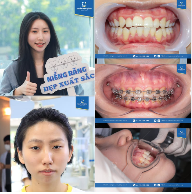 Niềng răng xong bỏ luôn ý định phẫu thật thẩm mỹ