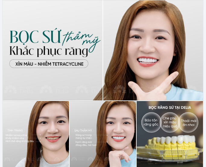 Nụ cười tối vì hàm răng nhiễm tetracycline từng khiến chị Thanh tự ti rất nhiều trong giao tiếp