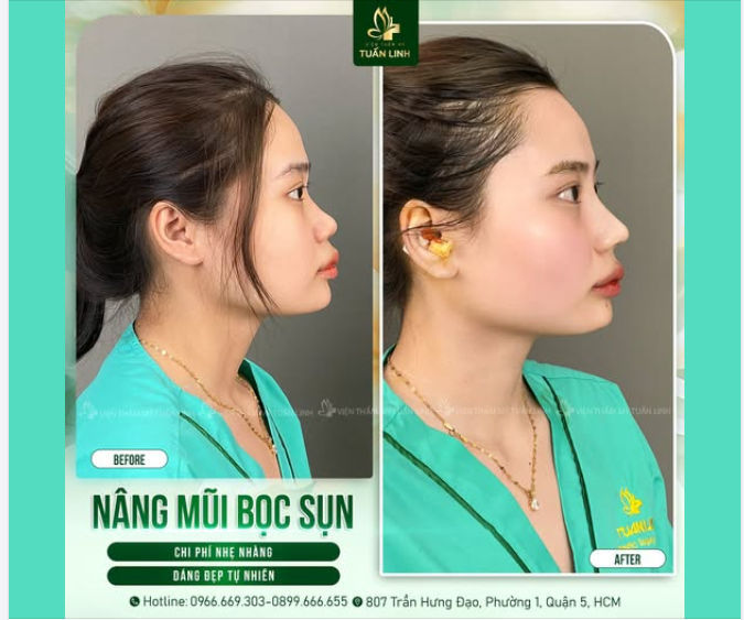 NÂNG MŨI BỌC SỤN - CHI PHÍ NHẸ NHÀNG - DÁNG ĐẸP TỰ NHIÊN!!